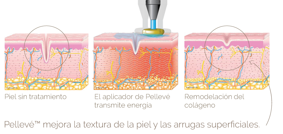 Pelleve tensamiento de la piel arrugas Medellin Dermatologa Beatriz