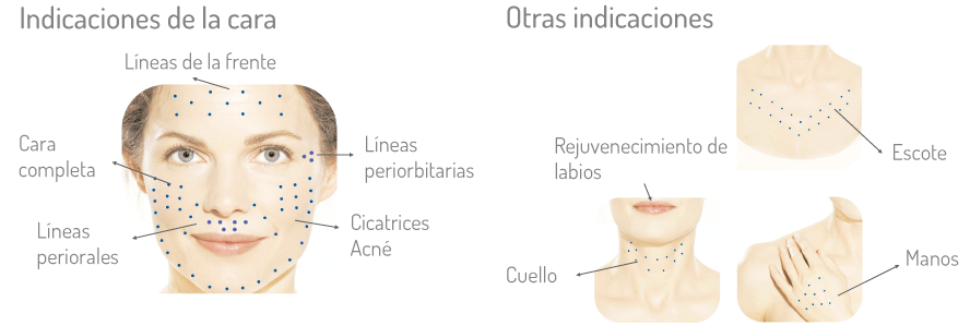 Restylane Medellin