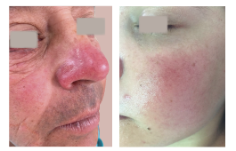 Tratamiento para rosacea en Medellin 02